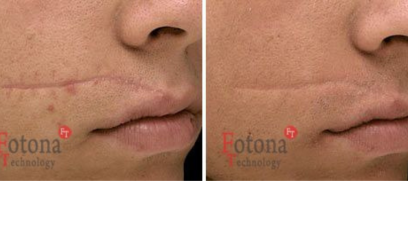 Фотона шлифовка рубцов 1